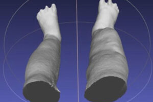 Portable 3-D scanner assesses patients with elephantiasis