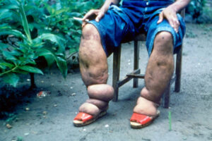 Gary Weil, MD, and his international colleagues spur new WHO guidelines for disabling tropical disease.