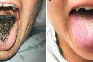 NEJM features two WashU ID cases, one cited in the Washington Post
