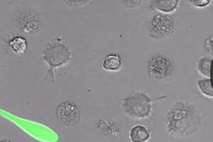 Liang Shan, PhD, assistant professor of medicine, and colleagues identified a potential way to eradicate the latent HIV infection that lies dormant inside infected immune cells