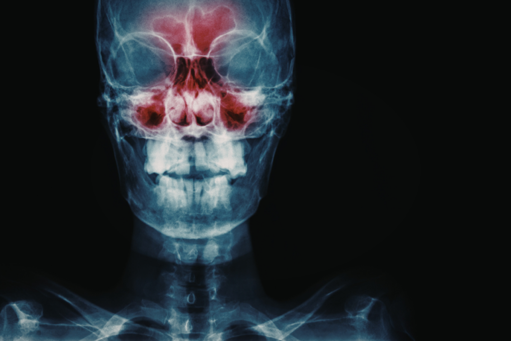 Illustration of an X-ray image of a person's head and shoulders, highlighting the sinus cavities in red. 
